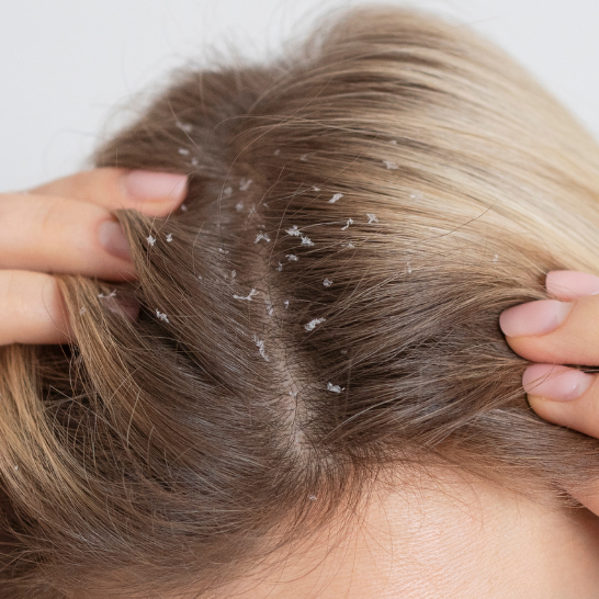 Dandruff