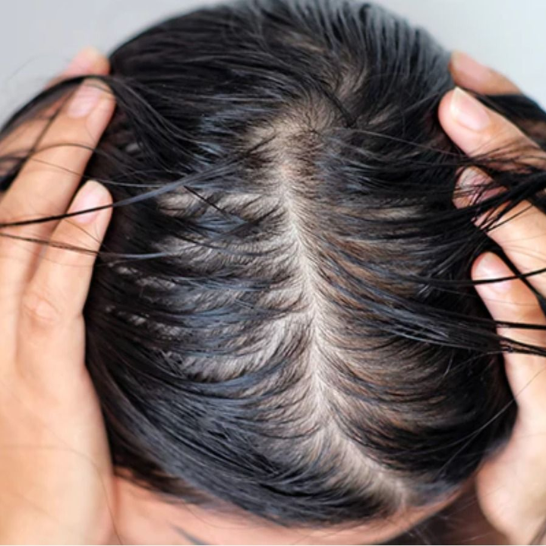 Oily Scalp